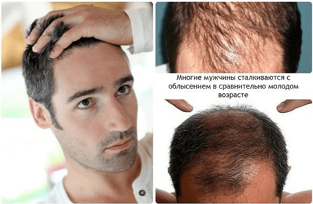 Шампунь от выпадения волос для мужчин – основные критерии выбора, рекомендации специалистов