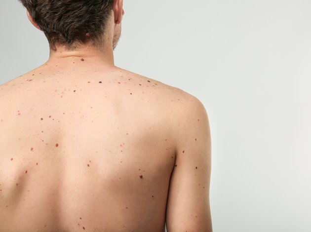  Как спастись от меланомы летом, когда риск рака кожи максимален 